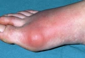 Bệnh Gout